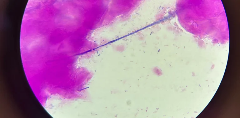 imagem post Anestesia no parto normal – tem limite mínimo e máximo de dilatação para aplicar?