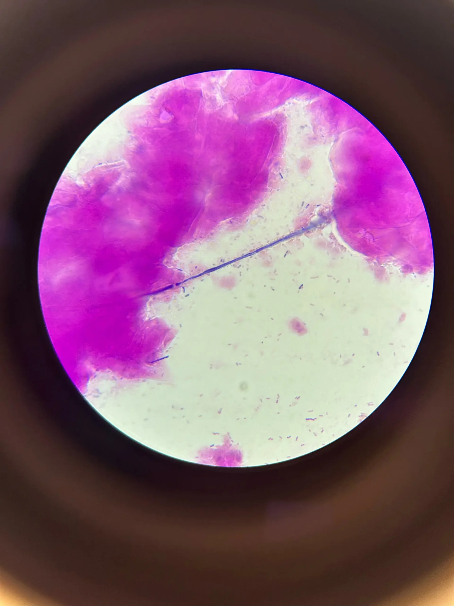 Anestesia no parto normal – tem limite mínimo e máximo de dilatação para aplicar?